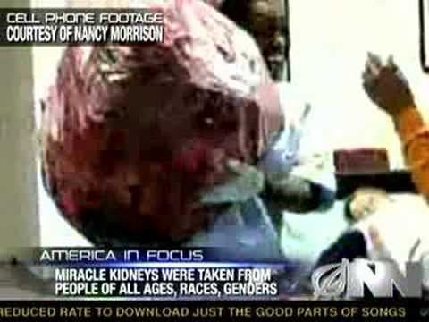 Anonym daroval nemocnici 200 lidských ledvin